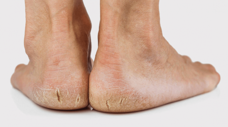 10 Amazing Home Remedies to Heal Cracked Heels